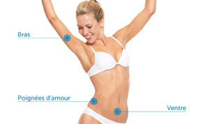 La cryolipolyse