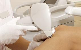 L’épilation laser